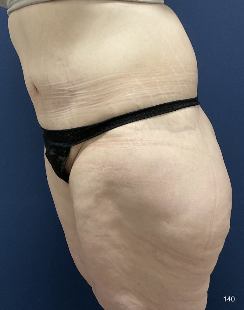 Tummy Tuck Before & After Gallery - Patient 184180573 - Image 6