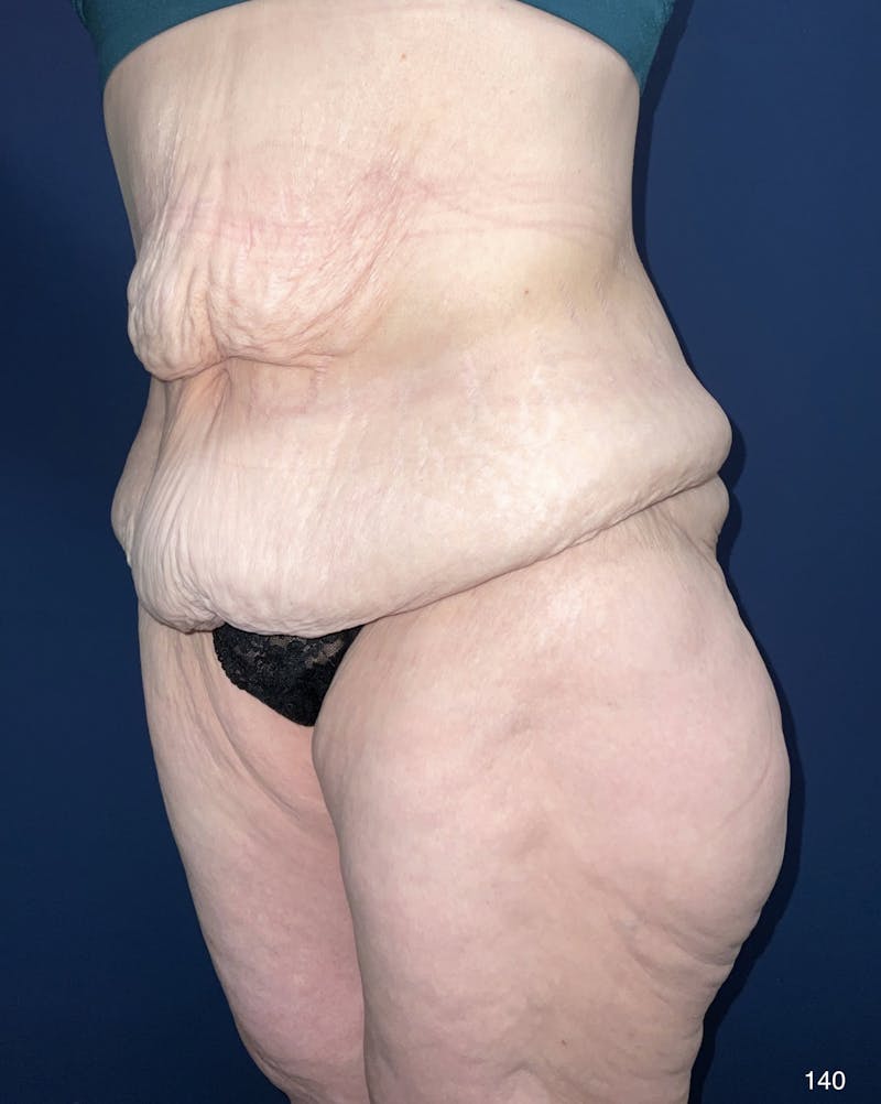 Tummy Tuck Before & After Gallery - Patient 184180573 - Image 5