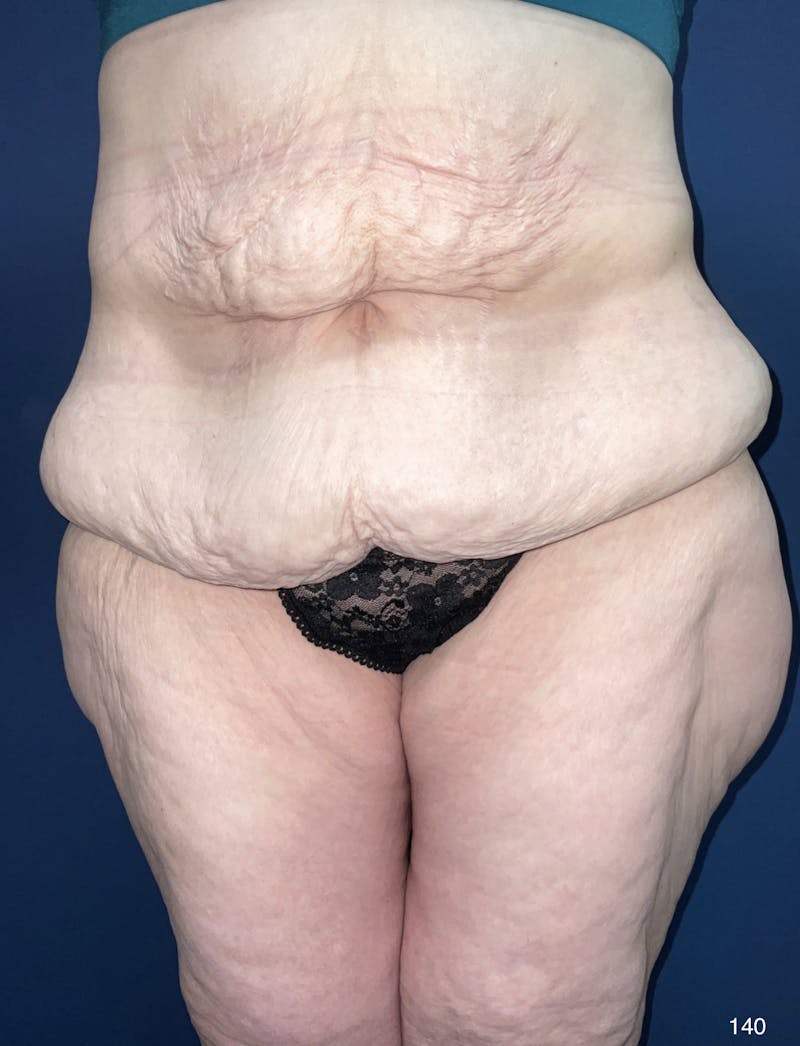 Tummy Tuck Before & After Gallery - Patient 184180573 - Image 1