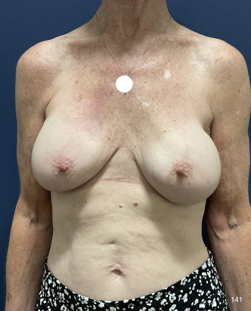 Capsulectomy Implant Exchange Before & After Gallery - Patient 184180576 - Image 1