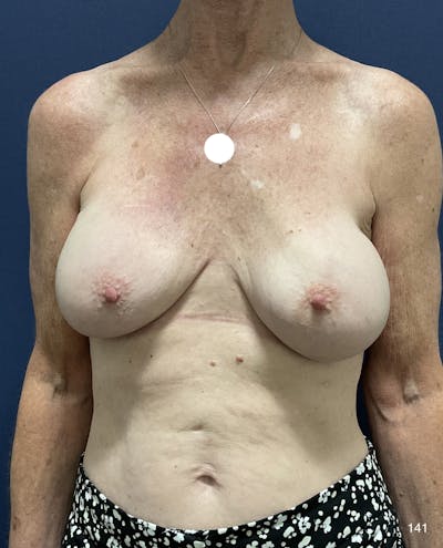 Capsulectomy Implant Exchange Before & After Gallery - Patient 184180576 - Image 1