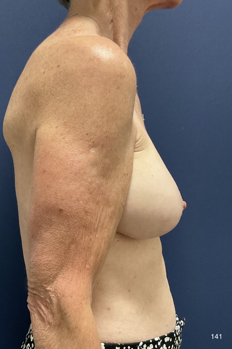Capsulectomy Implant Exchange Before & After Gallery - Patient 184180576 - Image 4