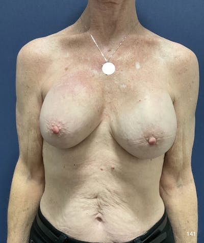 Capsulectomy Implant Exchange Before & After Gallery - Patient 184180576 - Image 2