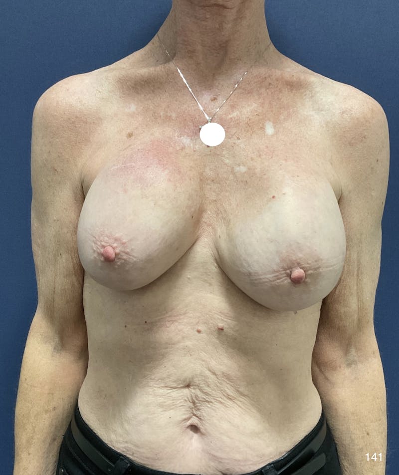 Capsulectomy Implant Exchange Before & After Gallery - Patient 184180576 - Image 2