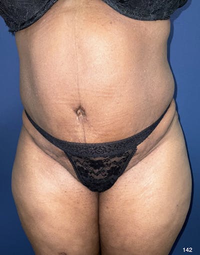 Tummy Tuck Before & After Gallery - Patient 184180577 - Image 2