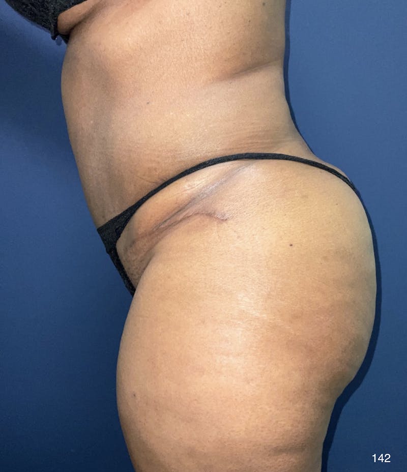 Tummy Tuck Before & After Gallery - Patient 184180577 - Image 4