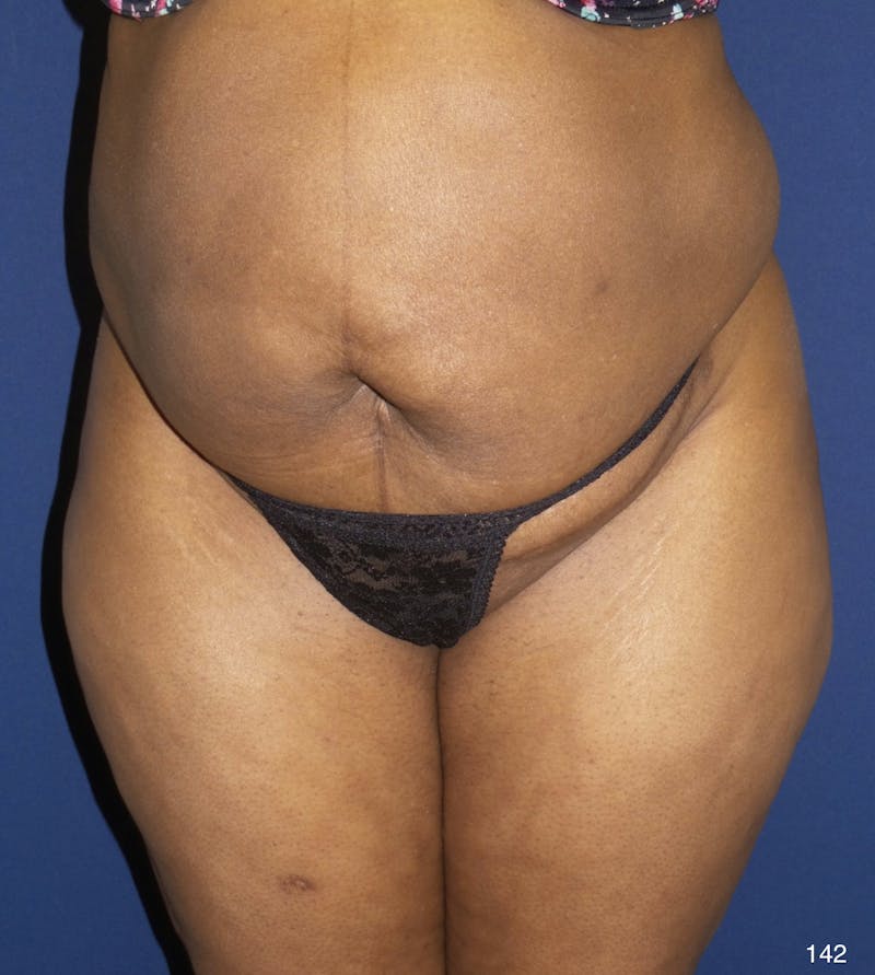 Tummy Tuck Before & After Gallery - Patient 184180577 - Image 1
