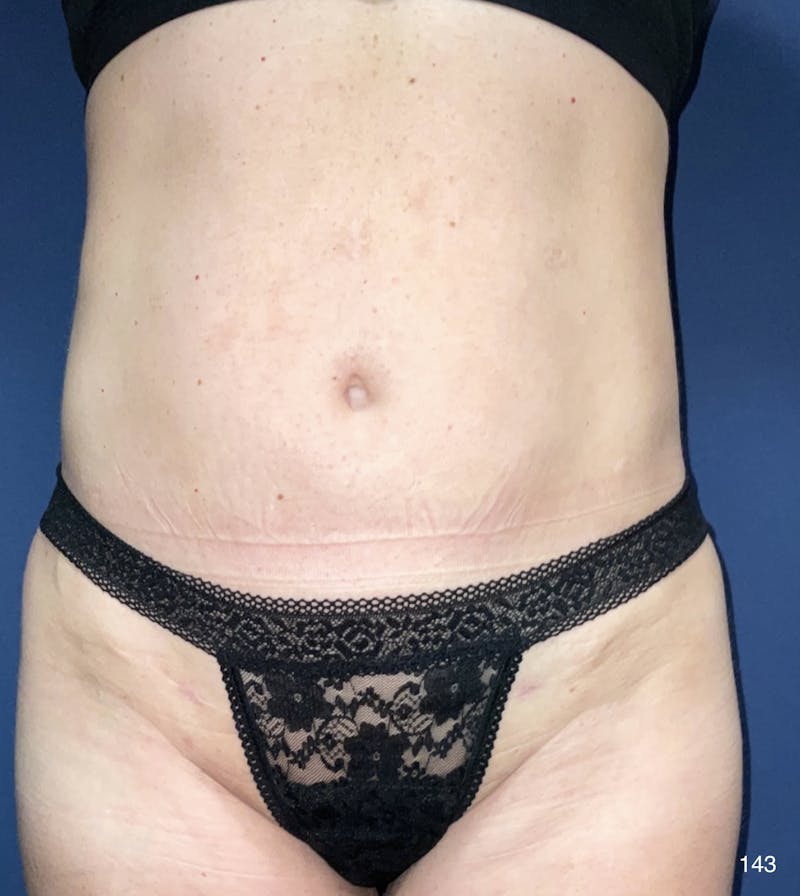 Liposuction Before & After Gallery - Patient 184180597 - Image 2