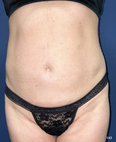 Liposuction Before & After Gallery - Patient 184180597 - Image 1