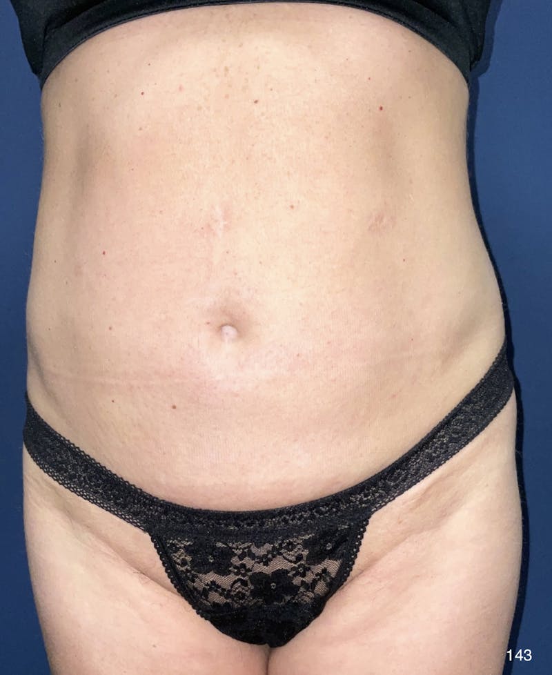 Liposuction Before & After Gallery - Patient 184180597 - Image 1