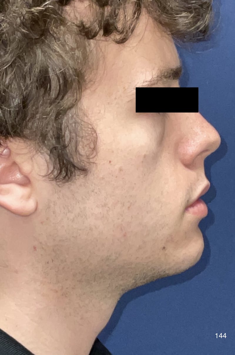 Chin Augmentation Before & After Gallery - Patient 184180619 - Image 4