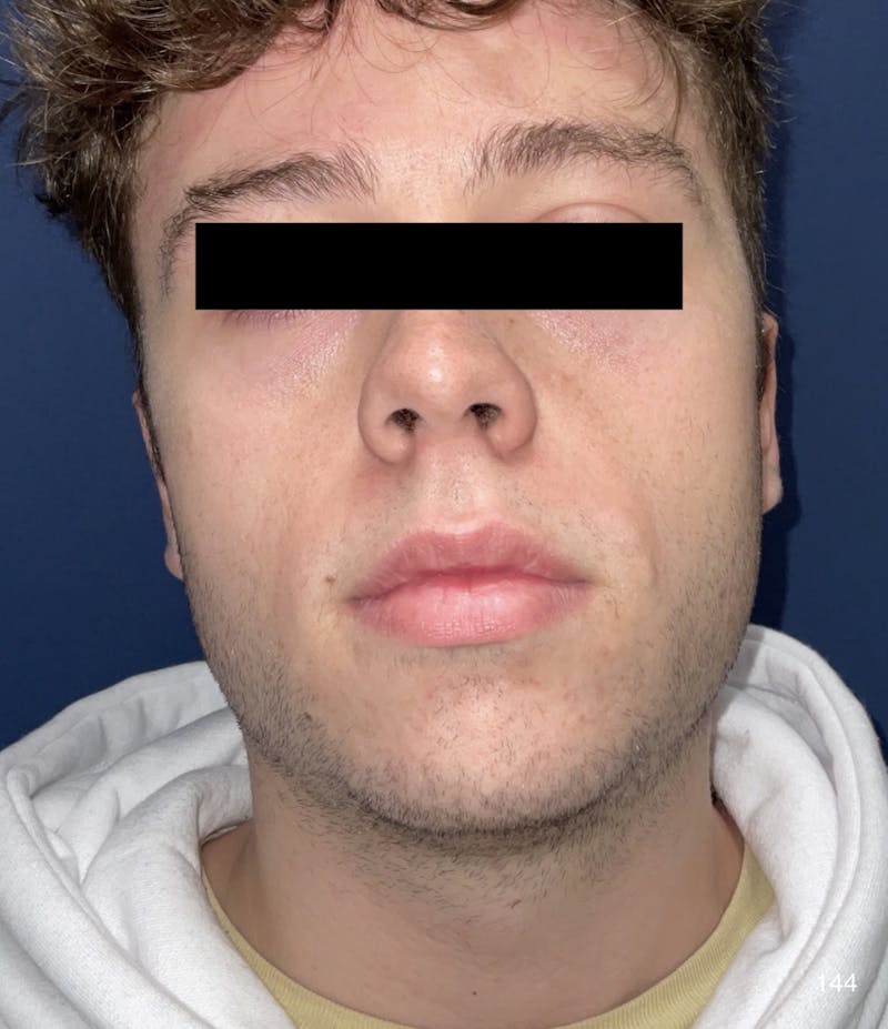 Chin Augmentation Before & After Gallery - Patient 184180619 - Image 1