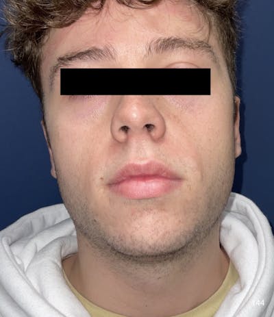 Chin Augmentation Before & After Gallery - Patient 184180619 - Image 1