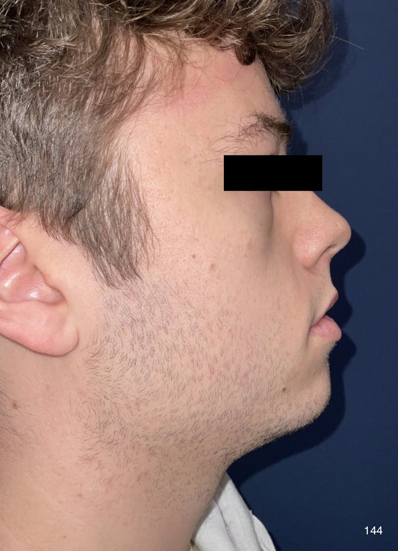 Chin Augmentation Before & After Gallery - Patient 184180619 - Image 3