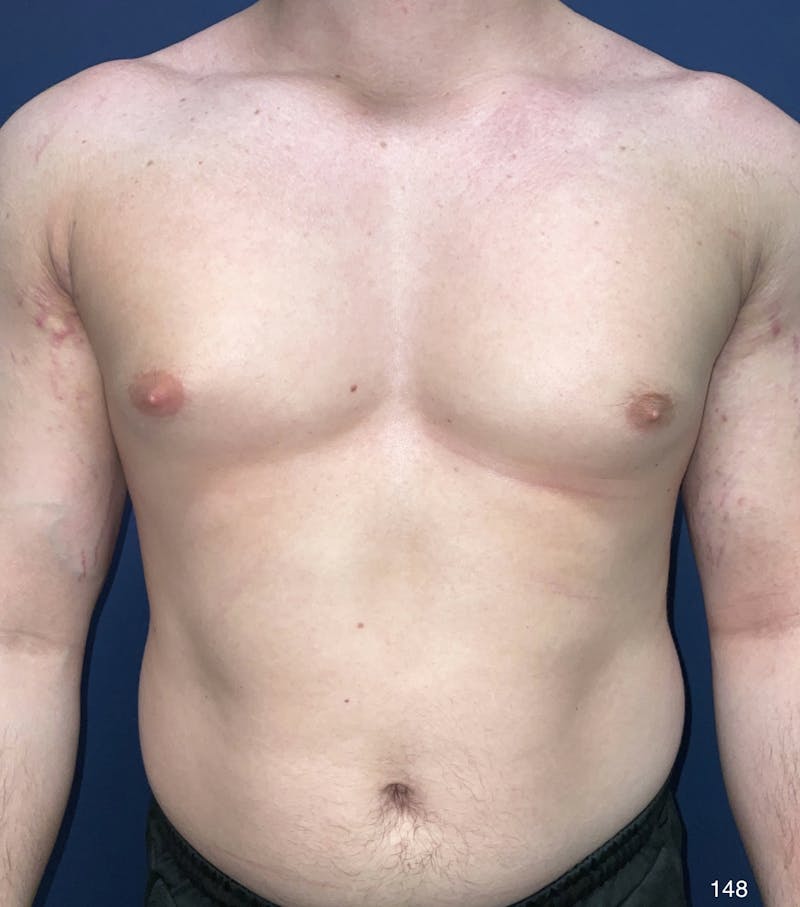 Gynecomastia Before & After Gallery - Patient 184180706 - Image 3
