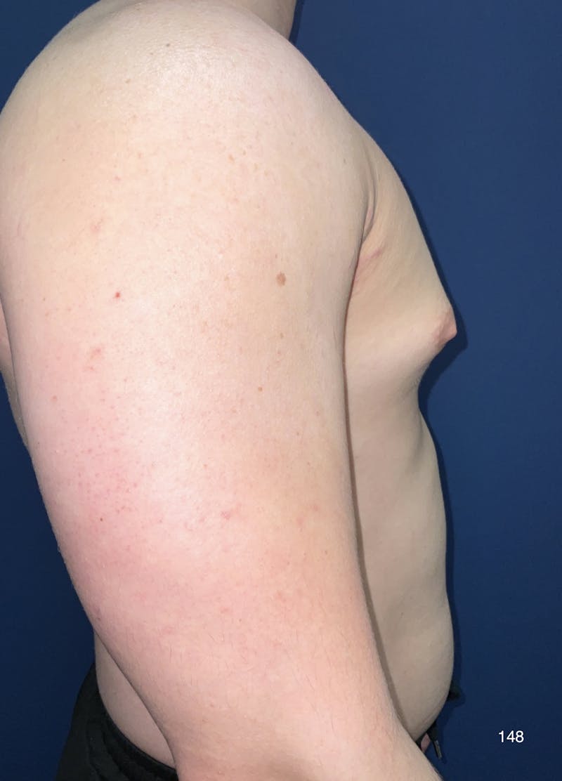 Gynecomastia Before & After Gallery - Patient 184180706 - Image 1