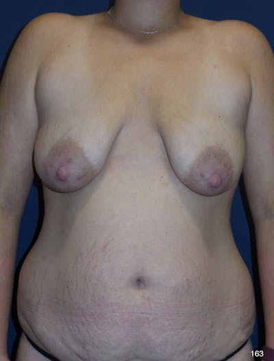 Tummy Tuck Before & After Gallery - Patient 184187302 - Image 1