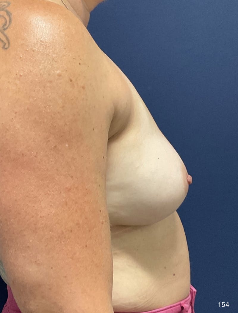 Capsulectomy Implant Exchange Before & After Gallery - Patient 184187365 - Image 4