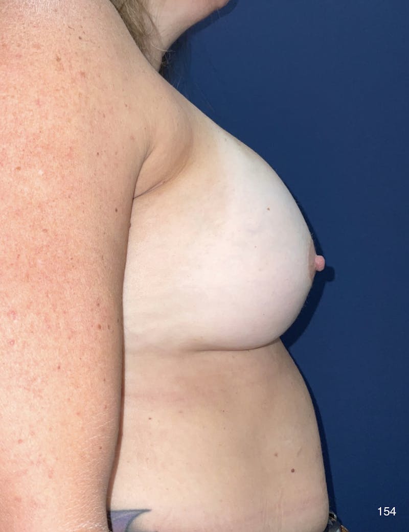 Capsulectomy Implant Exchange Before & After Gallery - Patient 184187365 - Image 3