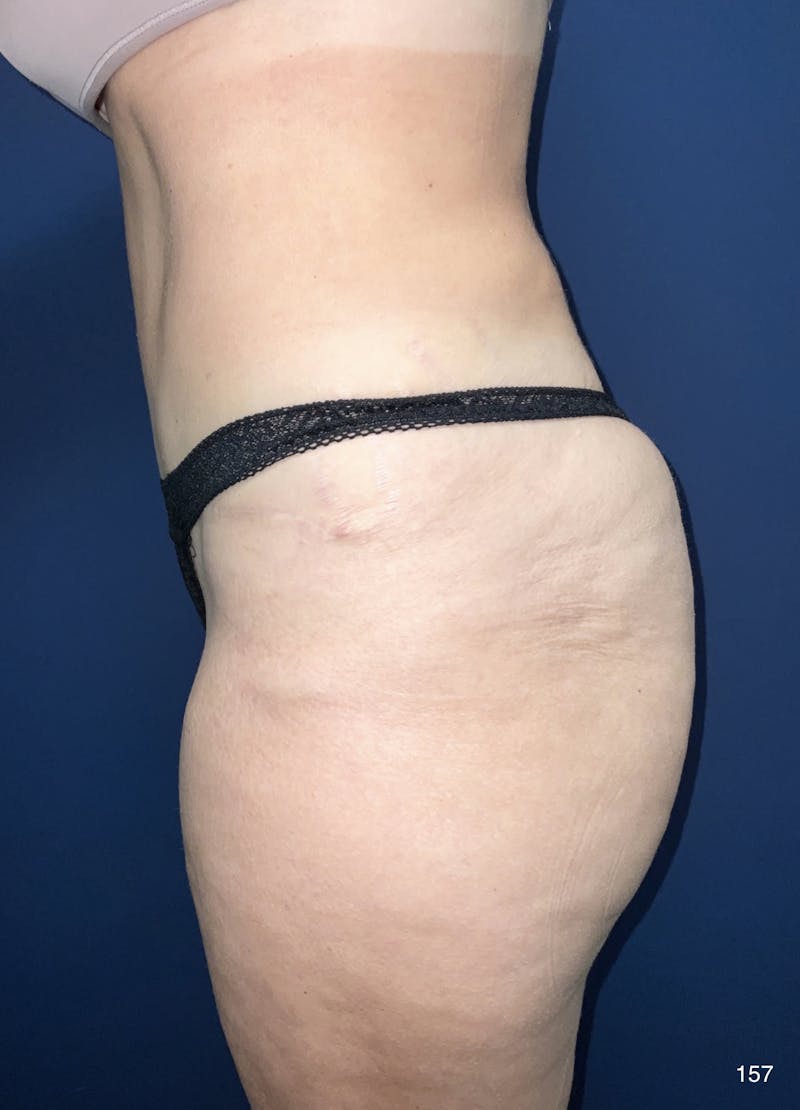 Tummy Tuck Before & After Gallery - Patient 184187434 - Image 4