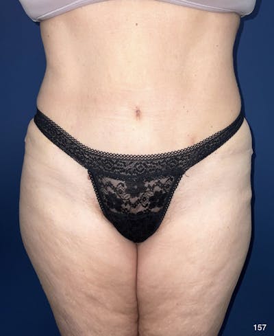 Tummy Tuck Before & After Gallery - Patient 184187434 - Image 2