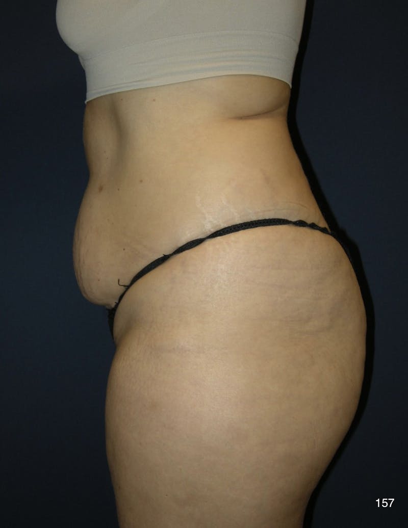 Tummy Tuck Before & After Gallery - Patient 184187434 - Image 3