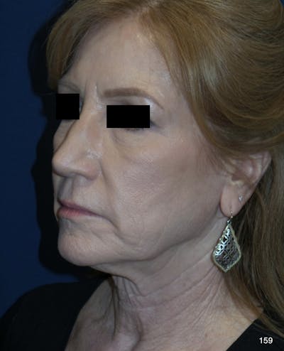 Neck Lift Before & After Gallery - Patient 184410875 - Image 1