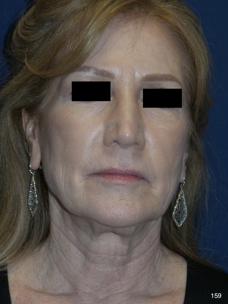 Neck Lift Before & After Gallery - Patient 184410875 - Image 3