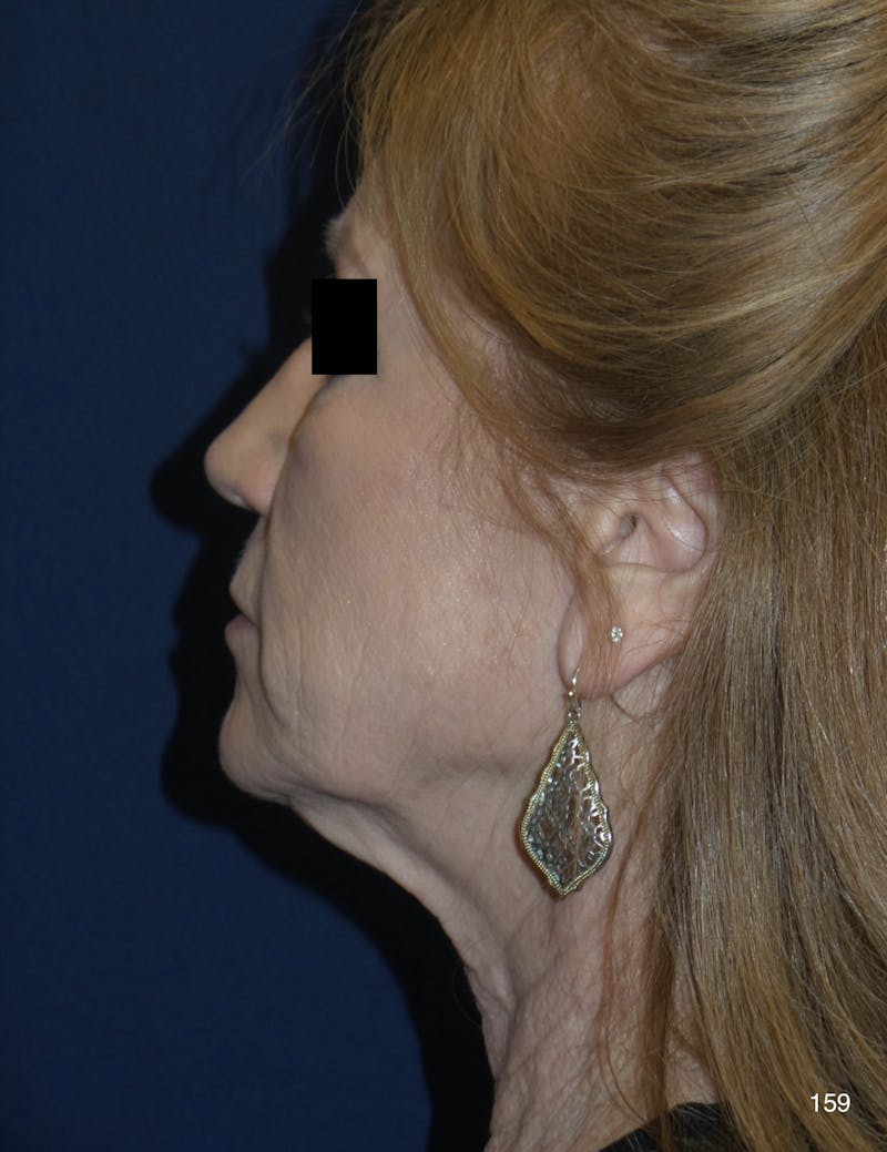 Neck Lift Before & After Gallery - Patient 184410875 - Image 5