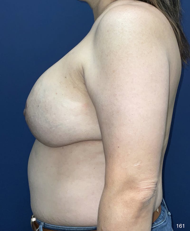 Capsulectomy Implant Exchange Before & After Gallery - Patient 184410884 - Image 4