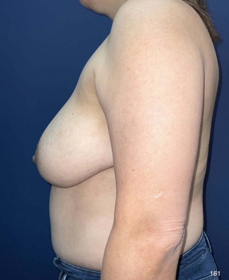 Capsulectomy Implant Exchange Before & After Gallery - Patient 184410884 - Image 3
