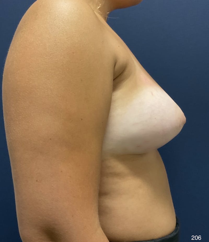 Breast Lift Before & After Gallery - Patient 184410946 - Image 6