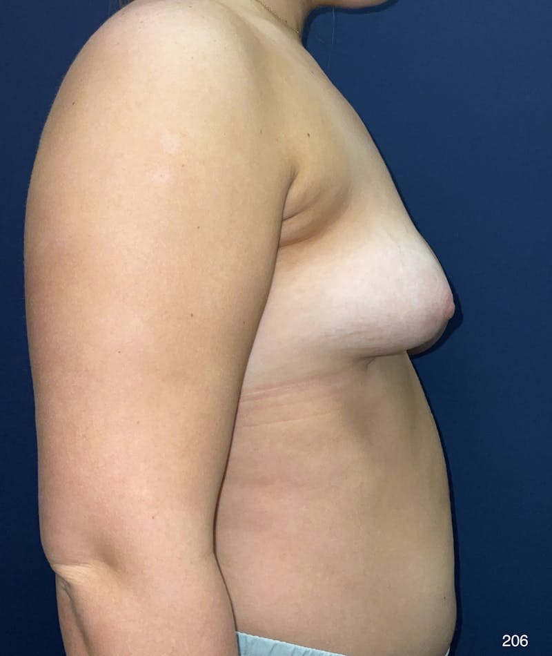 Breast Lift Before & After Gallery - Patient 184410946 - Image 5