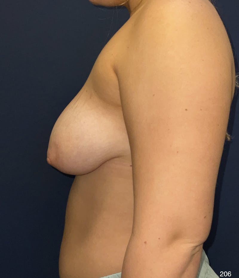 Breast Lift Before & After Gallery - Patient 184410946 - Image 7