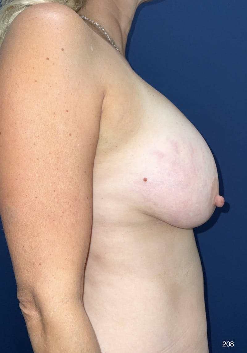 Breast Lift Before & After Gallery - Patient 184411113 - Image 3