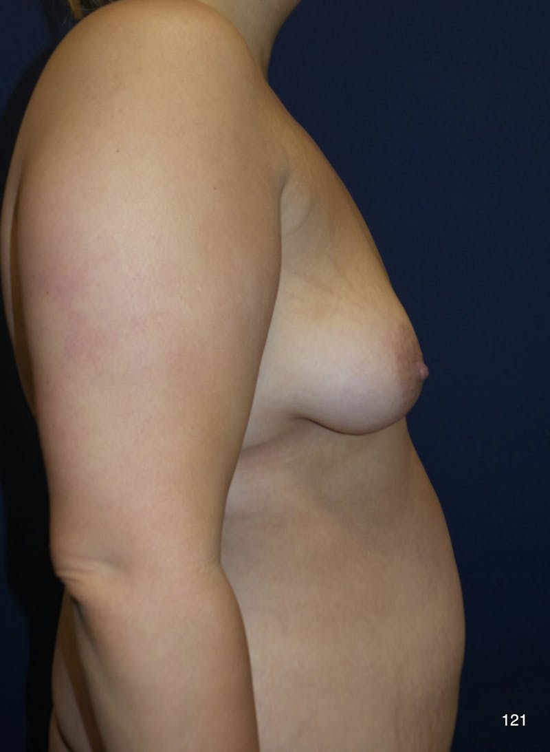 Fat Grafting to Breasts Before & After Gallery - Patient 180396624 - Image 5