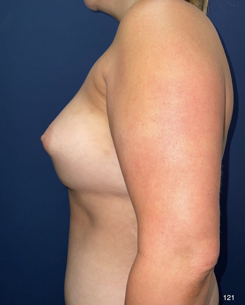 Fat Grafting to Breasts Before & After Gallery - Patient 180396624 - Image 4