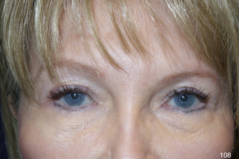 Blepharoplasty Before & After Gallery - Patient 222546 - Image 1