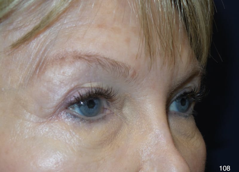 Blepharoplasty Before & After Gallery - Patient 222546 - Image 5