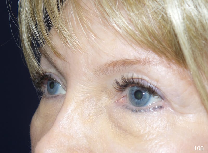 Blepharoplasty Before & After Gallery - Patient 222546 - Image 3