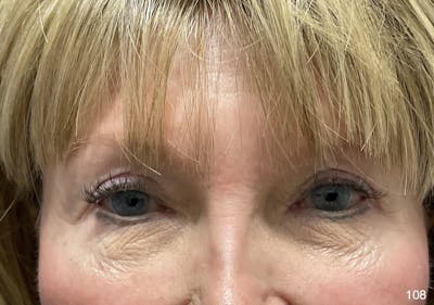 Blepharoplasty Before & After Gallery - Patient 222546 - Image 2