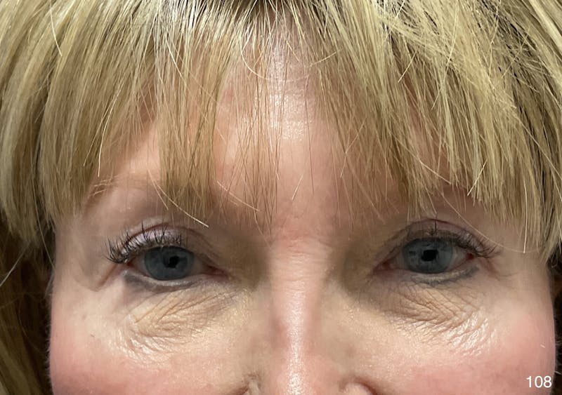Blepharoplasty Before & After Gallery - Patient 222546 - Image 2