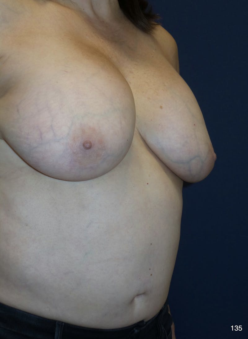 Capsulectomy Implant Exchange Before & After Gallery - Patient 198733 - Image 5