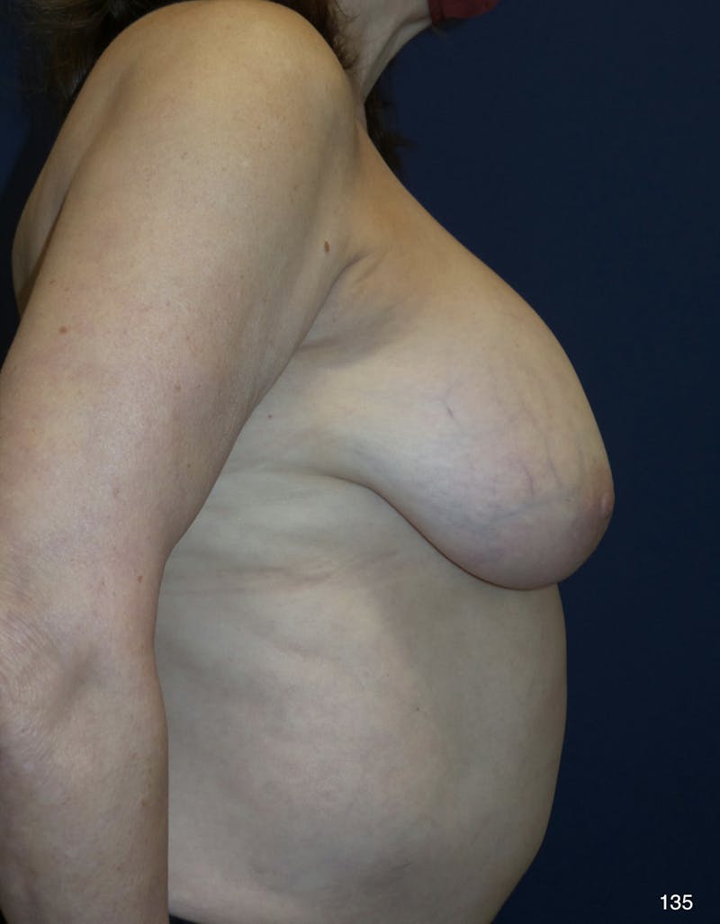 Capsulectomy Implant Exchange Before & After Gallery - Patient 198733 - Image 3