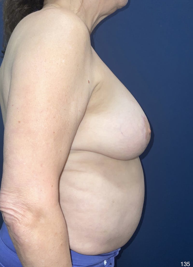 Capsulectomy Implant Exchange Before & After Gallery - Patient 198733 - Image 4