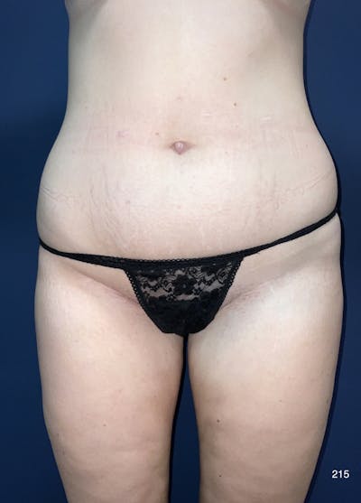 Liposuction Before & After Gallery - Patient 380684 - Image 1