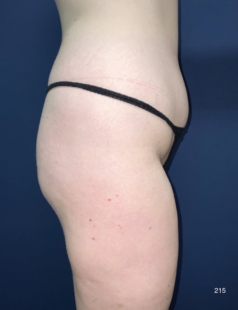 BodyTite/MorpheusBody Before & After Gallery - Patient 415346 - Image 3