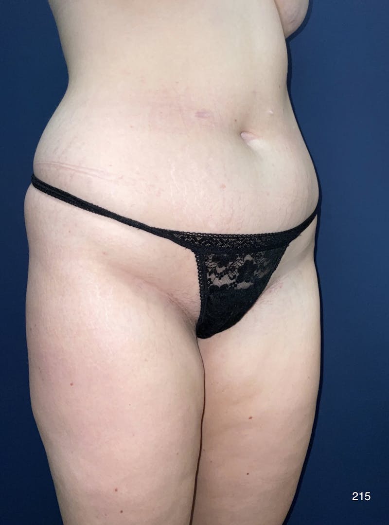 BodyTite/MorpheusBody Before & After Gallery - Patient 415346 - Image 5