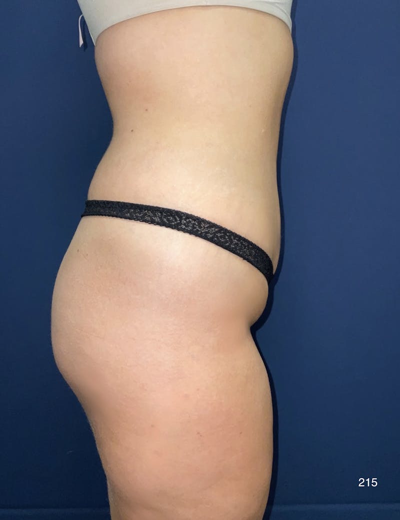 Liposuction Before & After Gallery - Patient 380684 - Image 4