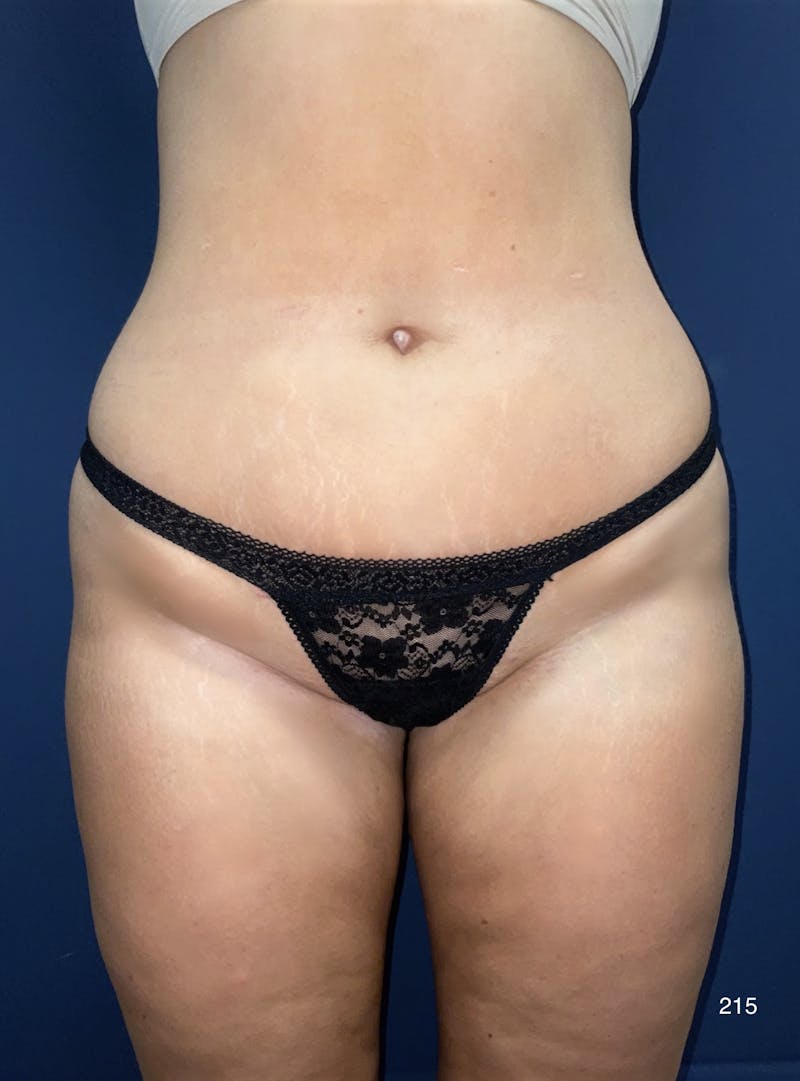 Liposuction Before & After Gallery - Patient 380684 - Image 2